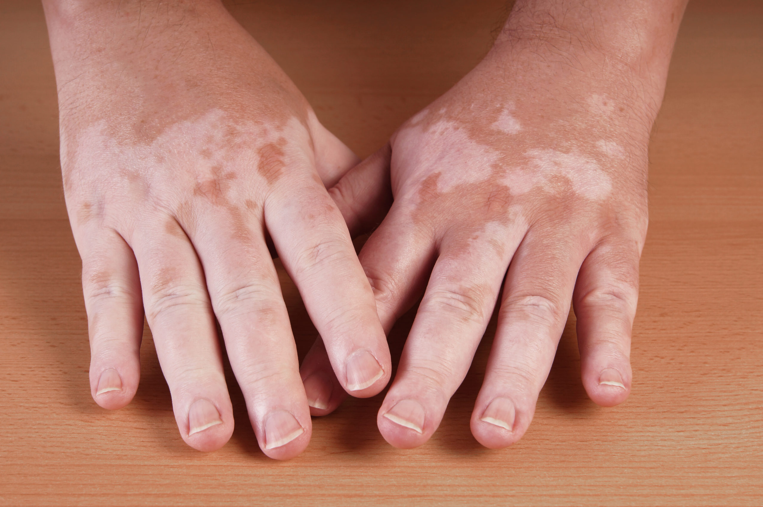 Vitiligo (Skin Pigment Disorders) - Glick Skin Institute