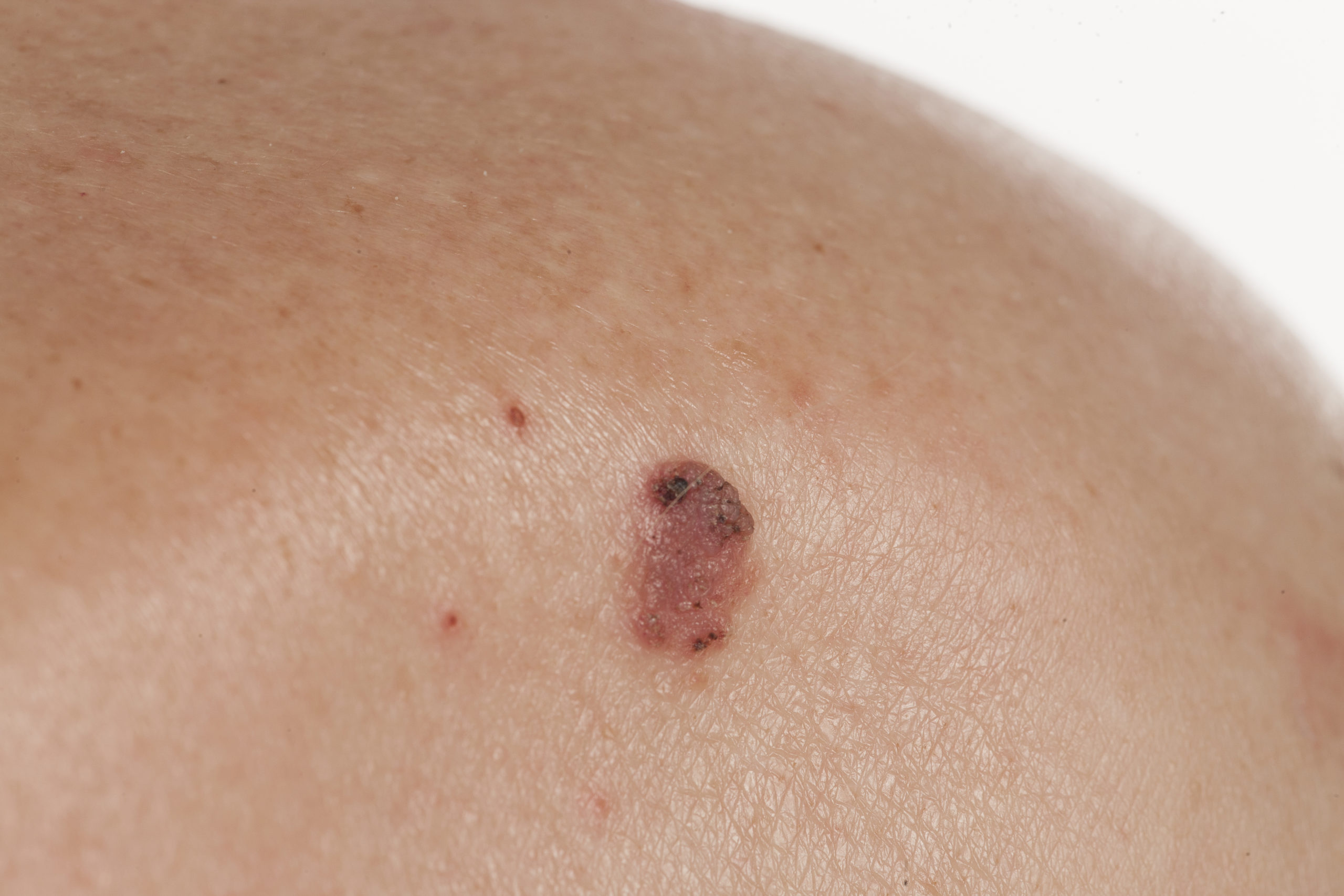 Skin Cancer Removal - Glick Skin Institute